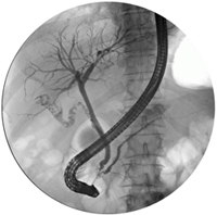 ERCP