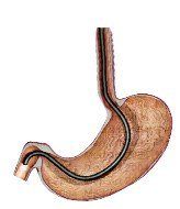 Gastroscopy/Endoscopy